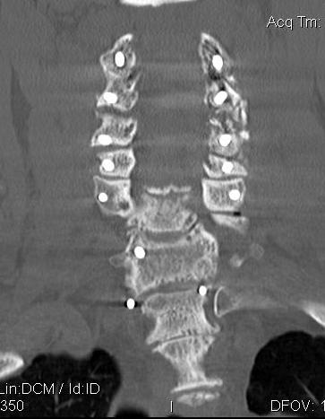 Cervical Myelopathy Posterior Decompression